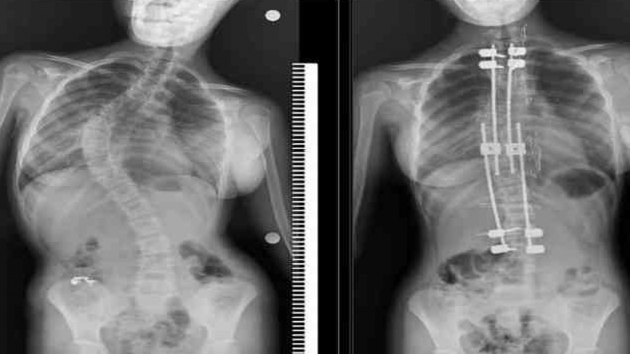 Skolyozlu çocuklar için doğru tedaviyle normal yaşam mümkün