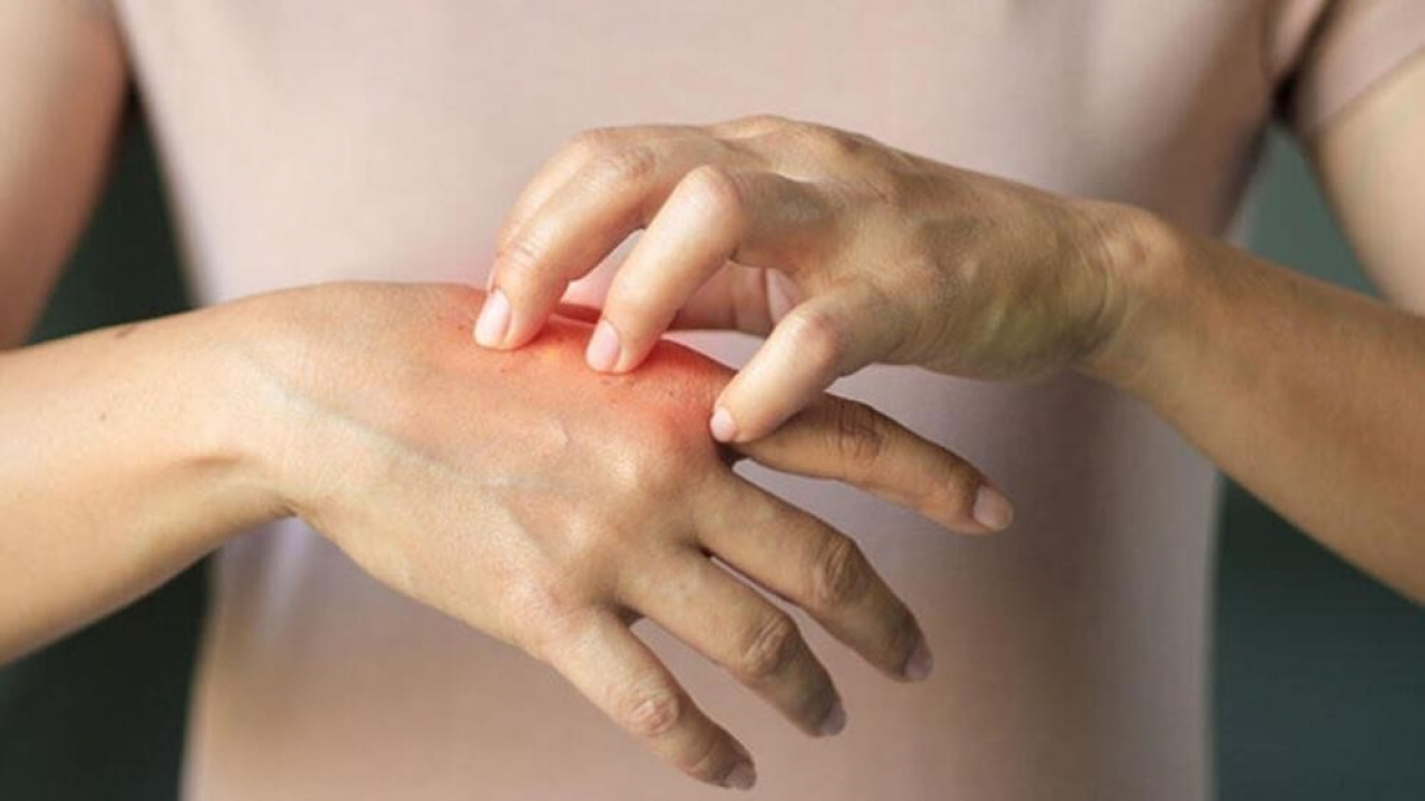 Soğuk hava cildi zorluyor: Kuruluk ve egzama şikâyetleri yükseldi