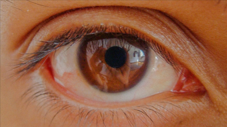 Glokomda erken teşhis kalıcı görme kaybını engelliyor