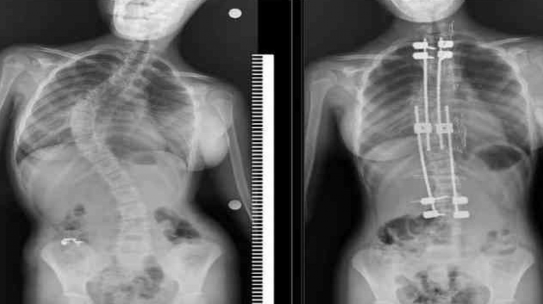 Skolyozlu çocuklar için doğru tedaviyle normal yaşam mümkün