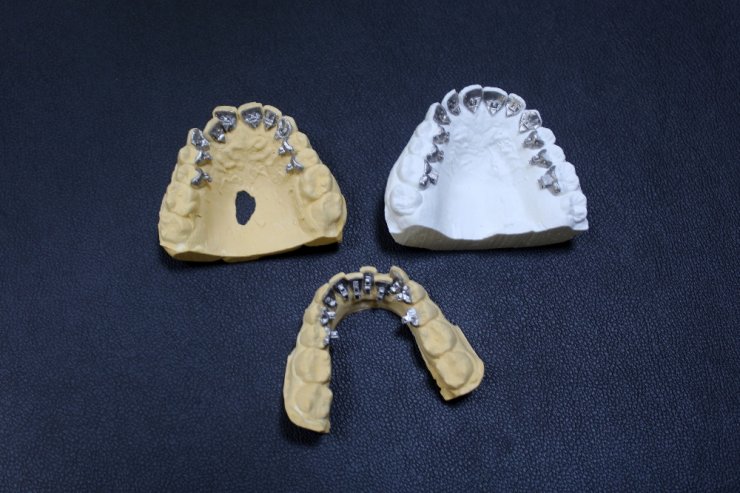 Türkiye’de ilk kez ’saklı’ diş teli üretildi
